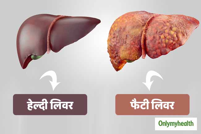नॉन-एल्कोहोलिक फैटी लिवर