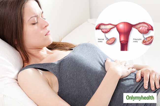 पॉलिसिस्टिक ओवेरियन सिंड्रोम