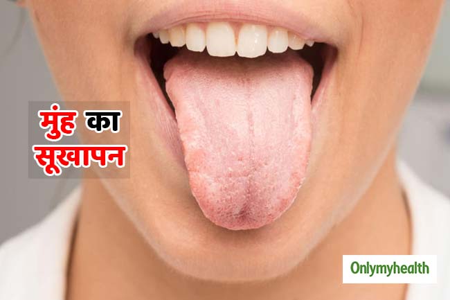 मुंह सूखने की समस्या