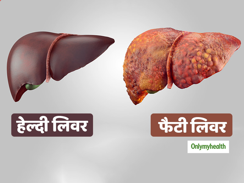 फैटी लिवर के संकेत हैं हर समय थकान और कमजोरी, इससे बचने के लिए डाइट में ये 4 बदलाव