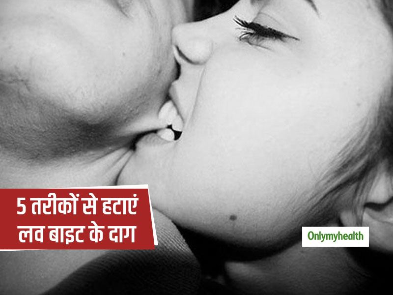 लव बाइट के निशान
