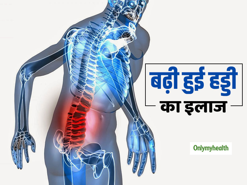 बढ़ी हुई हड्डियों के इलाज (Deformity Correction) के लिए क्यों जरूरी है सर्जरी, जानें एक्सपर्ट की राय