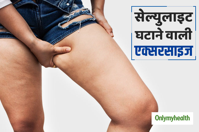 थुलथुली-लटकती त्वचा और सेल्युलाइट