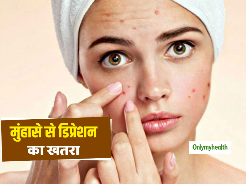 Acne Causing Depression: मुंहासे भी आपको बना सकते हैं डिप्रेशन का शिकार, 63% बढ़ जाता है खतरा: शोध