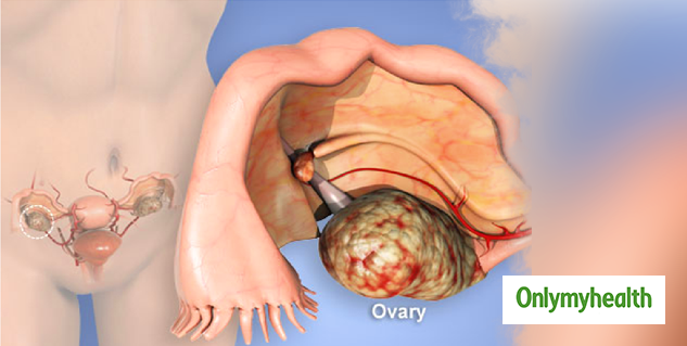 Ovarian-Cancer