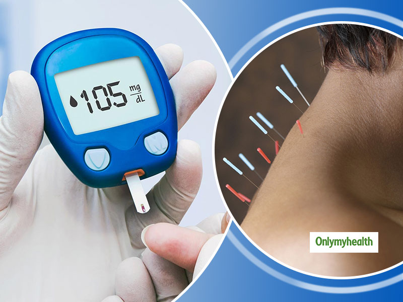 Acupuncture: 20 मिनट के एक्यूपंक्चर थेरेपी से ठीक हो सकता है डायबिटीज, जानें कैसे काम करती है ये तकनीक