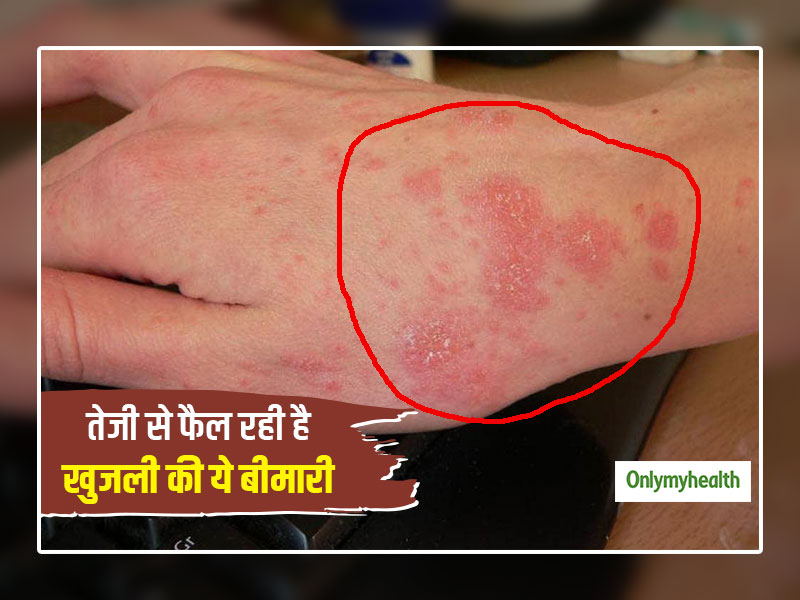 महामारी की तरह फैल रहा है खुजली वाला रोग 'स्केबीज', छोटे बच्चों और बड़ों में दिखते हैं ये लक्षण