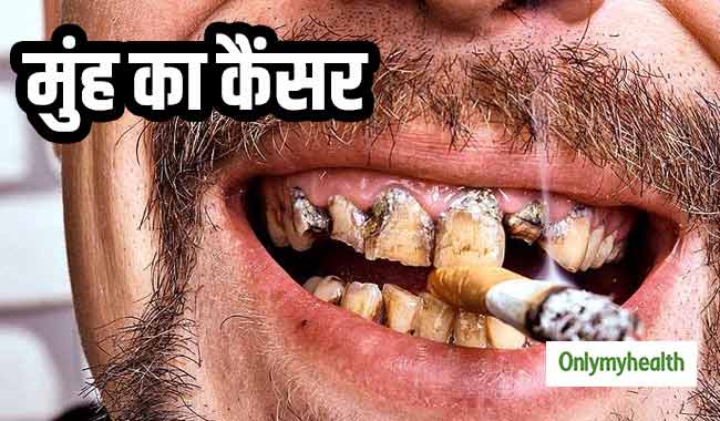 विश्व कैंसर दिवस : मप्र में हर साल मुंह और फेफड़े के कैंसर से मरते हैं हजारों लोग, जानें बचाव के तरीके