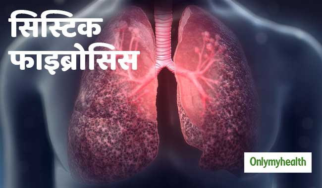 सिस्टिक फाइब्रोसिस में कब पड़ती है लंग्स ट्रांसप्लांट की जरूरत, जानें जरूरी बातें