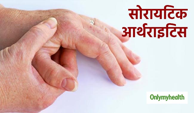 उंगलियों में सूजन सोरायटिक आर्थराइटिस के हैं संकेत, एक्सपर्ट से जानें इसके कारण और उपचार