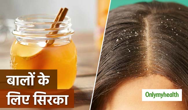डेंड्रफ दूर करने में औषधी से भी बढ़कर है सिरका, जानें इसके फायदे के बारे में