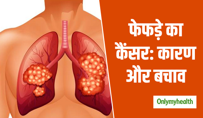 फेफड़े के कैंसर में कारगर है इम्यूनोथेरेपी, एक्सपर्ट से जानें कारण और बचाव