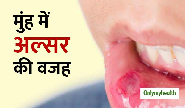 तम्बाकू ही नहीं, इन 7 कारणों से हो सकता है मुंह में अल्सर, जानें बचाव और उपचार