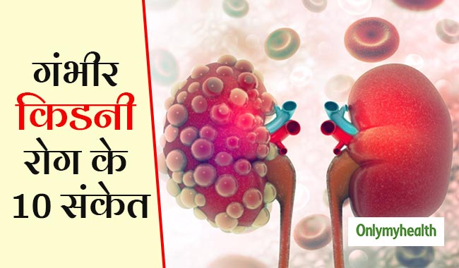 किडनी की गंभीर बीमारी का संकेत हैं ये 10 लक्षण, जानें क्यों खतरनाक है किडनी रोग