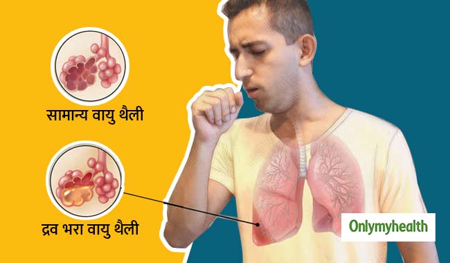 बैक्टीरिया और वायरस है निमोनिया की प्रमुख वजह, जानें इसके लक्षण और उपचार