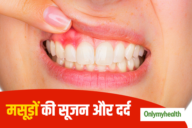 मसूड़ों की सूजन