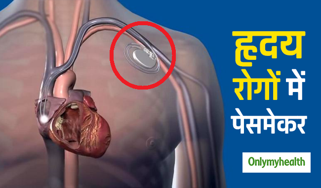 हार्ट के रोगों में कब पड़ती है पेसमेकर लगाने की जरूरत, जानें कैसे होती है सर्जरी