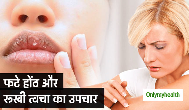 फटे होंठ और रूखी त्वचा से रातोंरात छुटकारा दिलाते हैं ये 5 आसान उपाय