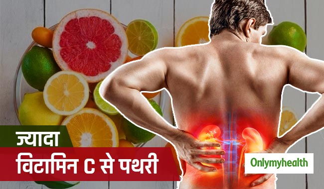 किडनी की पथरी का कारण बन सकता है ज्यादा 'विटामिन सी' का सेवन, जानें कारण