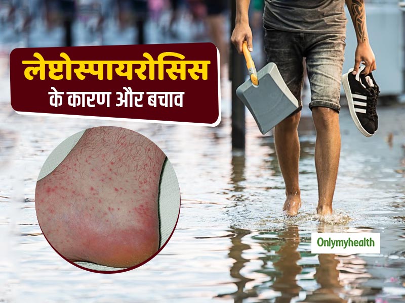 बाढ़ और बारिश के पानी से हो सकती है लेप्टोस्पायरोसिस की समस्या, भुगतने पड़ सकते हैं गंभीर परिणाम