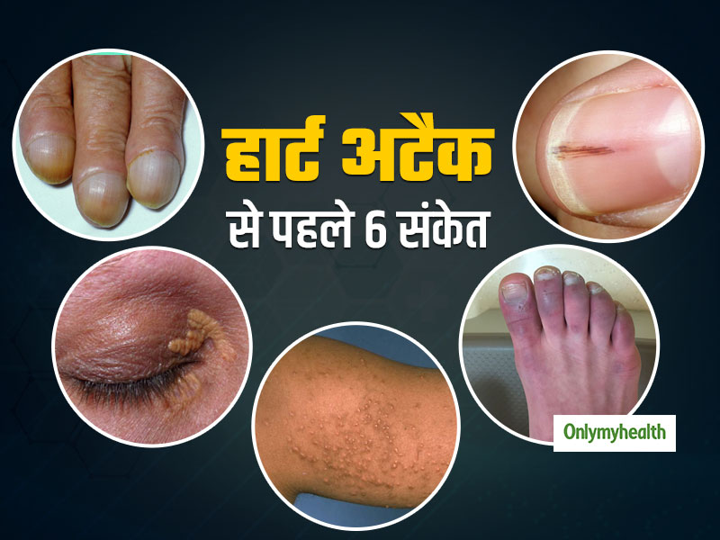 Heart Attack Warning Signs: त्वचा पर दिखने वाले ये 6 निशान हो सकते हैं 'हार्ट अटैक' का पूर्व संकेत, 35+ उम्र वाले रहें सावधान