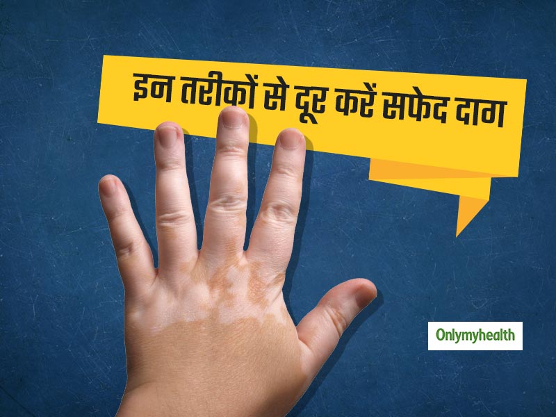हाथ, पैर या होंठों पर हैं सफेद दाग (Leukoderma) तो इस तरीके से करें इन्हें दूर, जल्द मिलेगी राहत