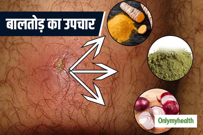 रामबाण उपायों से करें बालतोड़ ठीक