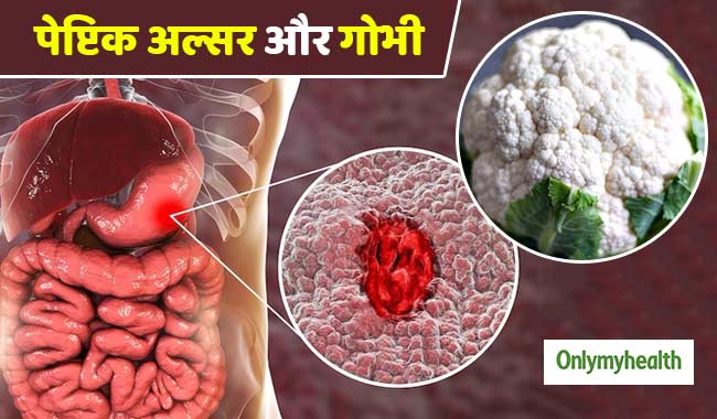 पेप्टिक अल्सर में बहुत फायदेमंद है फूलगोभी, इस तरह खाने से दूर होगी कब्ज