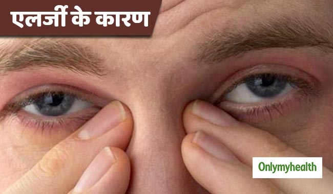 कुछ लोग क्यों होते हैं एलर्जी के जल्दी शिकार? जानें इससे बचाव के तरीके