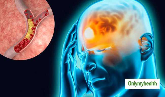 कोलेस्ट्रॉल बढ़ने से मस्तिष्क पर पड़ता है बुरा असर, जानें क्यों