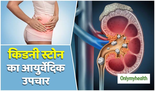 "बिना ऑपरेशन के 9 से 10 mm के किडनी स्टोन को आसानी से निकाला जा सकता है" पढ़ें आयुर्वेदिक एक्सपर्ट की सलाह