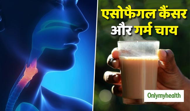 लगातार गर्म चाय पीने से होता है एसोफेगल कैंसर का खतरा, पुरुष होते हैं जल्दी प्रभावित