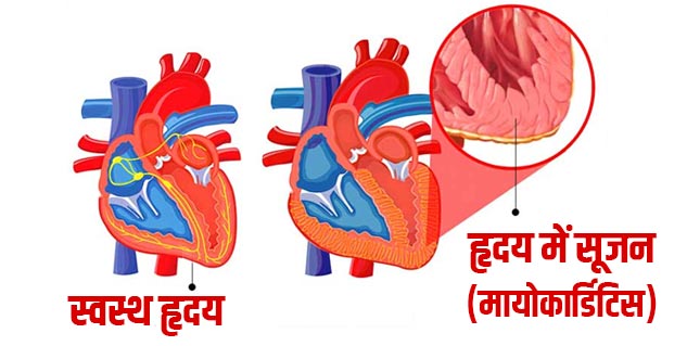 Myocarditis-In-Hindi