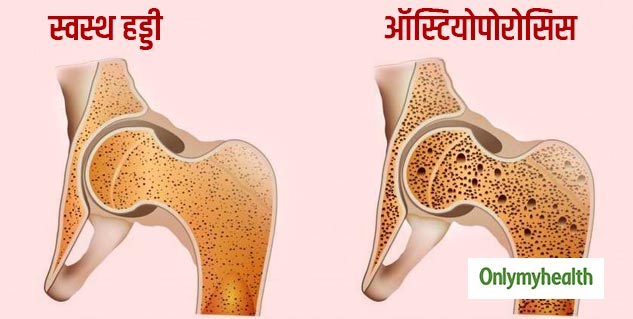 World-Osteoporosis-Day-In-Hindi