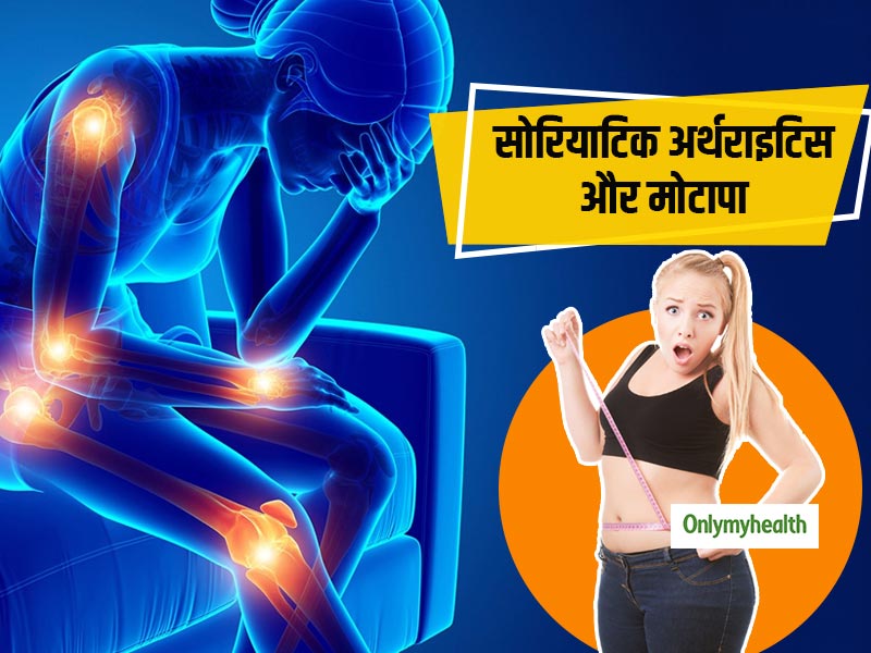 जोड़ों में सूजन और अकड़न है 'सोरियाटिक अर्थराइटिस' के संकेत, अधिक वजन वाले रहें सावधान