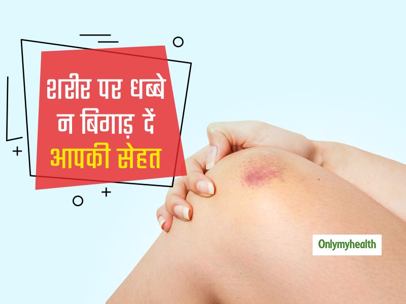 शरीर पर पड़े ये धब्बे कहीं बिगाड़ न दे आपकी सेहत, इन 3 घरेलू नुस्खों से करें इन्हें दूर