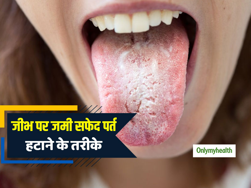White Tongue: जीभ पर जमी सफेद मोटी पर्त और दरारों को मिटाने के 5 आसान घरेलू उपाय