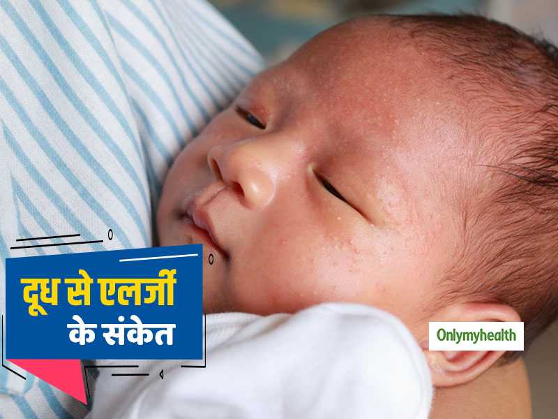 बच्चों के लिए खतरनाक हो सकती है दूध से एलर्जी की समस्या, जानें इसके लक्षण, कारण और इलाज