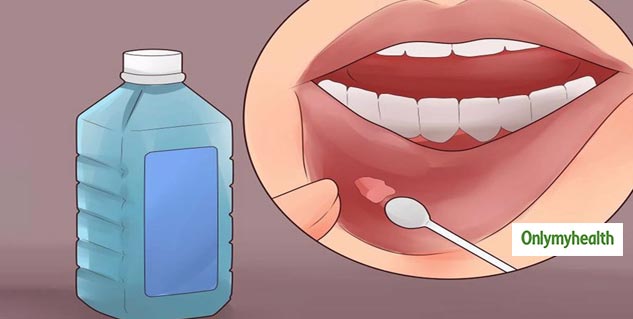 insidehomeremediesfoemouthulcer