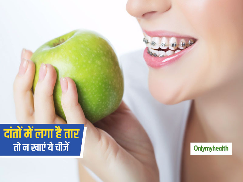 अगर दांतों में लगे हुए हैं ब्रेसेस या तार, तो भूलकर भी न खाएं ये 4 चीजें, हो सकता है नुकसान