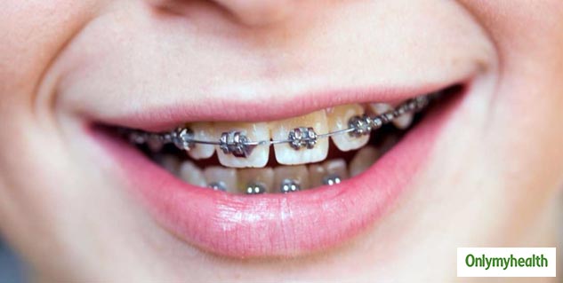 Foods Avoid WithBraces