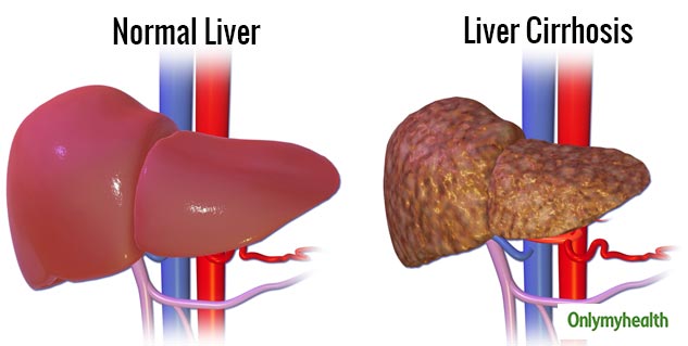 FATTY LIVER