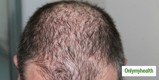 hair fall remedies for men