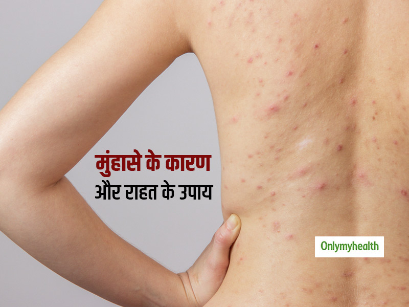चेहरा हो या माथा या फिर जांघ, पीठ और हाथ, मुहांसों से हुआ बुरा हाल? जानें इनका कारण और बचाव के आसान टिप्स