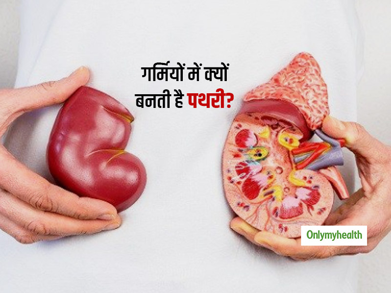 गर्मी में 20 % बढ़ जाते हैं गुर्दे की पथरी के मामले! जानें क्यों गर्म और उमस भरे मौसम में ज्यादा बनती है पथरी