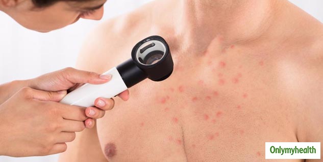 Reason Behind Chest Acne