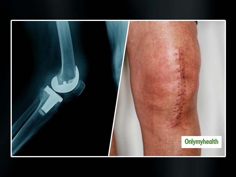Knee Replacement Surgery: क्या है घुटनों की रिप्लेसमेंट सर्जरी से जुड़े खतरे? जानें क्या कहते हैं एक्सपर्ट्स