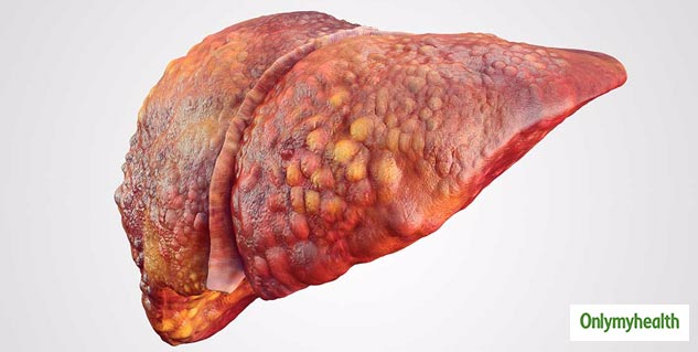 -fatty-liver