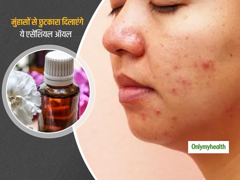 Essential Oils For Acne: मुंहासों की समस्या को जड़ से दूर करने में मददगार हैं ये 5 एसेंशियल ऑयल