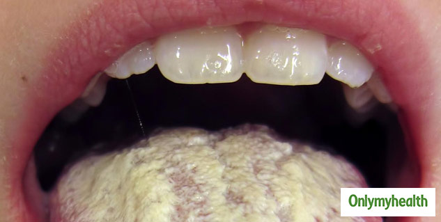 candida infection in mouth